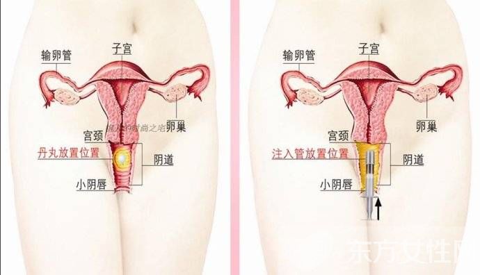 盆腔炎的癥狀與治療方法 這些癥狀有可能是盆腔炎
