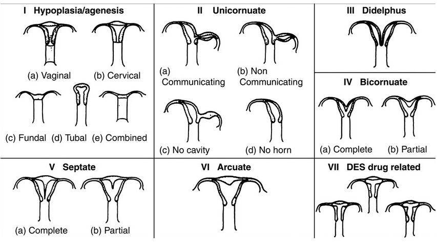 子宮畸形會(huì)引起不孕 這是真的嗎